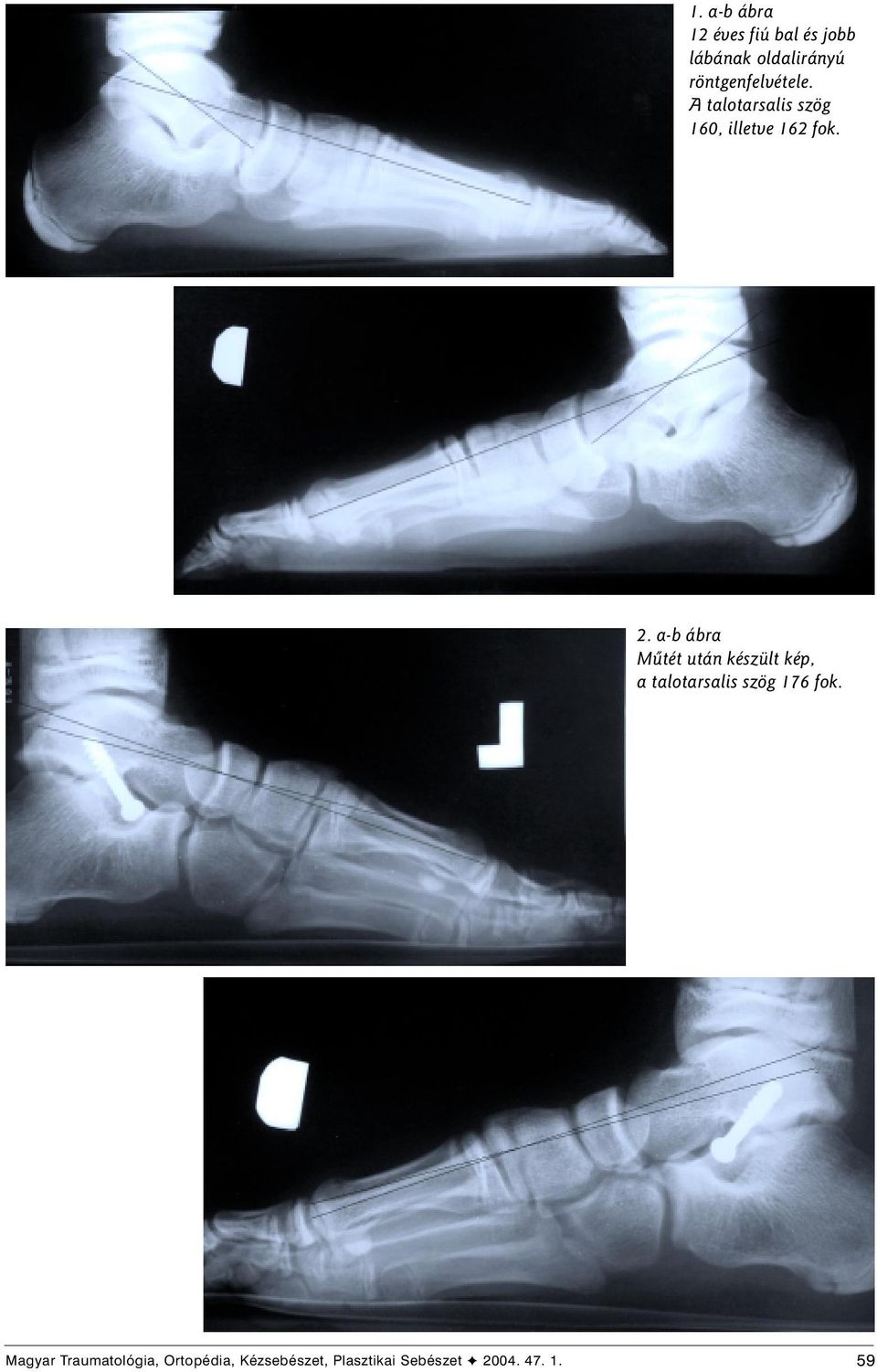 a-b ábra Mûtét után készült kép, a talotarsalis szög 176 fok.