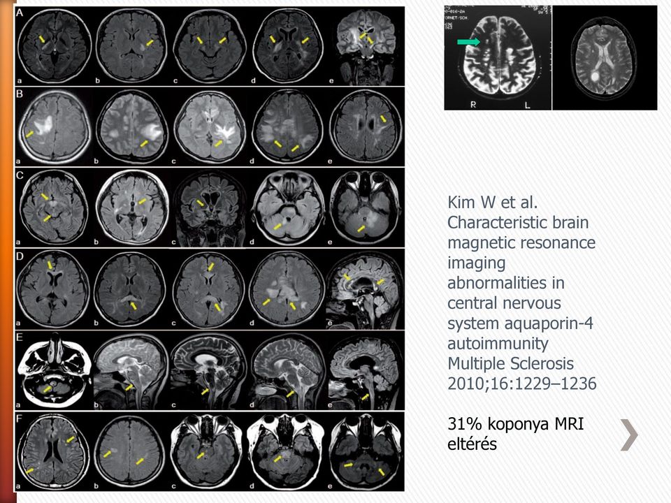 imaging abnormalities in central nervous