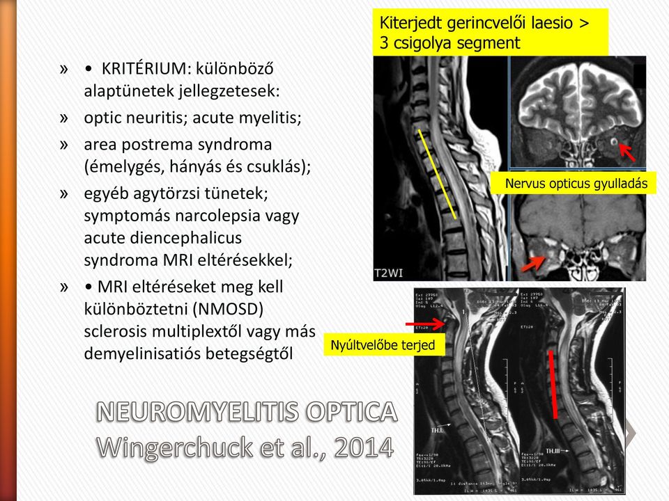 syndroma MRI eltérésekkel;» MRI eltéréseket meg kell különböztetni (NMOSD) sclerosis multiplextől vagy más