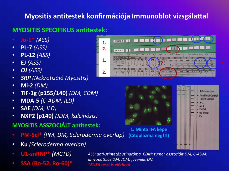 ASSZOCIÁLT antitestek: PM Scl* (PM, DM, Scleroderma overlap) Ku (Scleroderma overlap) U1 snrnp* (MCTD) SSA (Ro 52, Ro 60)* 1.