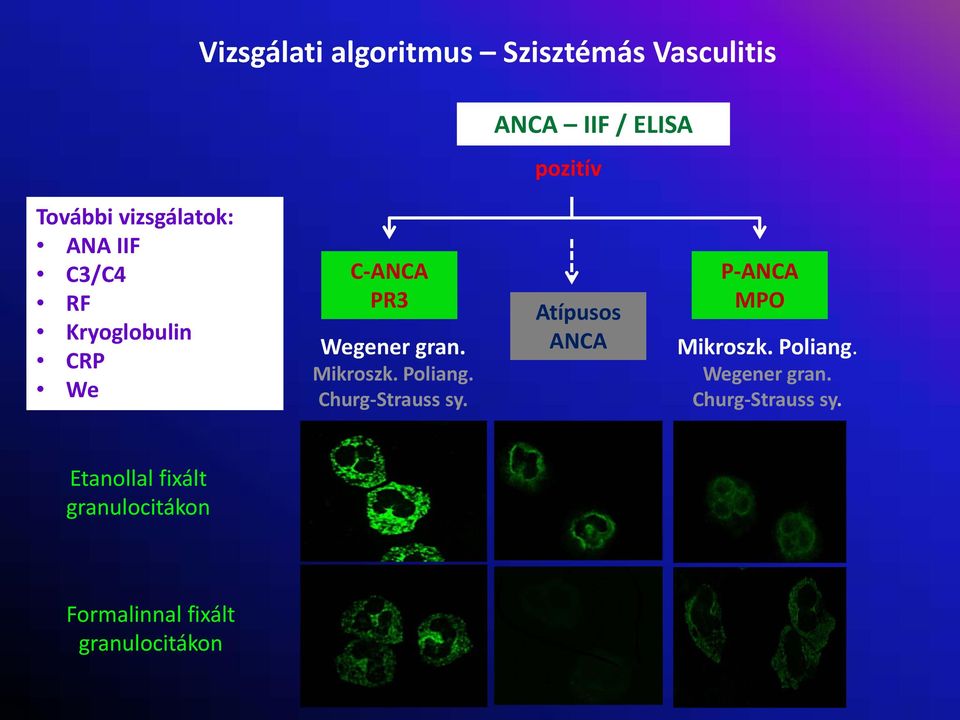 Mikroszk. Poliang. Churg Strauss sy. Atípusos ANCA P ANCA MPO Mikroszk. Poliang. Wegener gran.