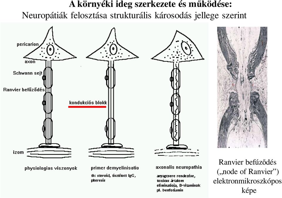 károsodás jellege szerint Ranvier