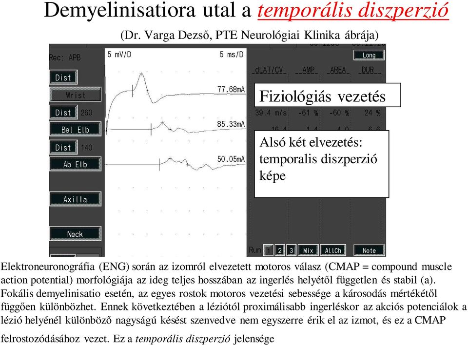 válasz (CMAP = compound muscle action potential) morfológiája az ideg teljes hosszában az ingerlés helyétől független és stabil (a).