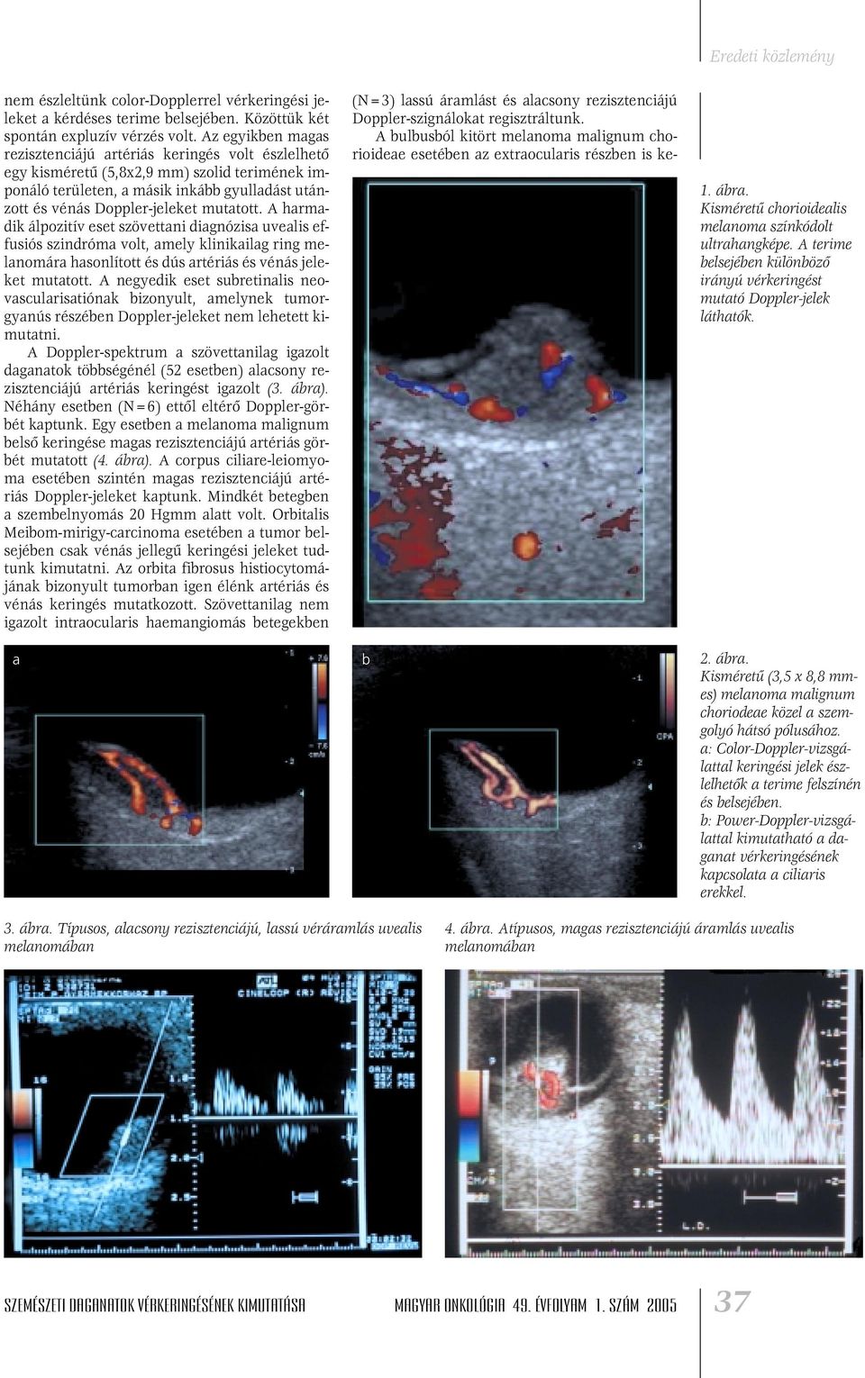 A harmadik álpozitív eset szövettani diagnózisa uvealis effusiós szindróma volt, amely klinikailag ring melanomára hasonlított és dús artériás és vénás jeleket mutatott.