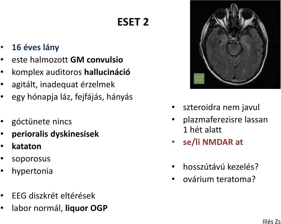 kataton soporosus hypertonia EEG diszkrét eltérések labor normál, liquor OGP szteroidra nem