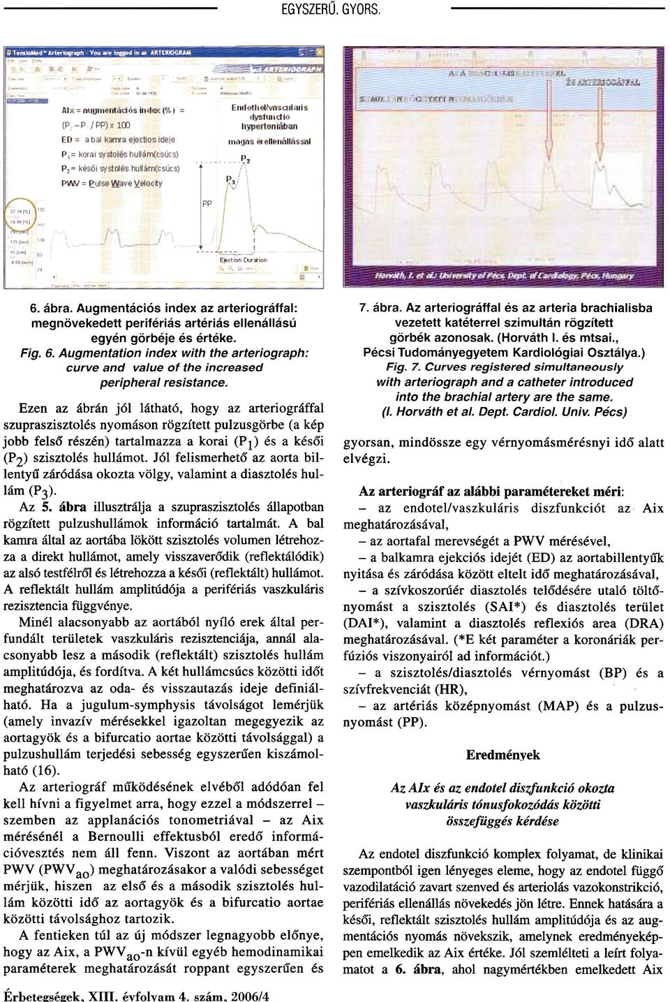 Augmentációs index az arteriográffal: megnövekedett perifériás artériás ellenállású egyén görbéje és értéke. Fig. 6.