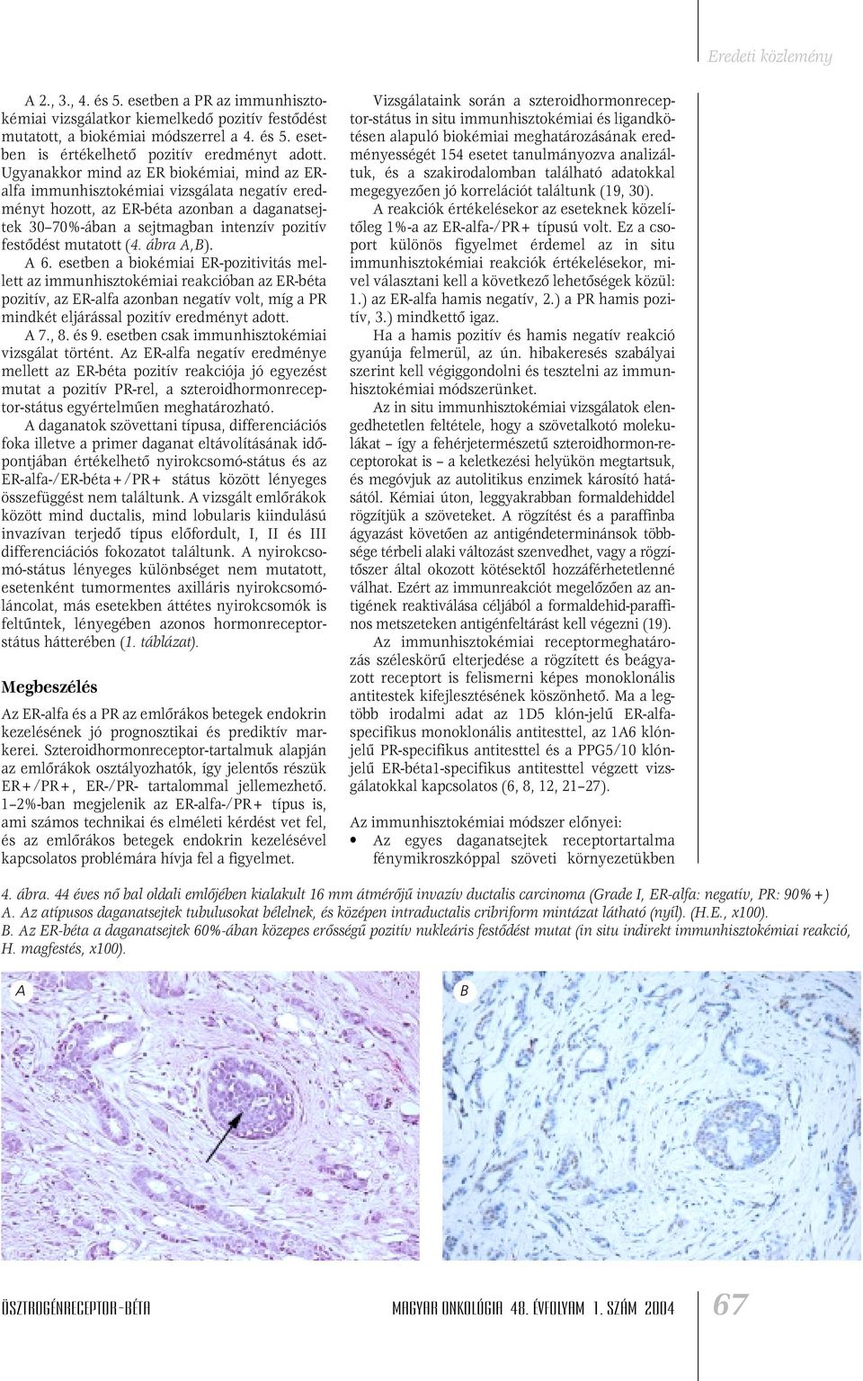 (4. ábra A,B). A 6. esetben a biokémiai ER-pozitivitás mellett az immunhisztokémiai reakcióban az ER-béta pozitív, az ER-alfa azonban negatív volt, míg a PR mindkét eljárással pozitív eredményt adott.