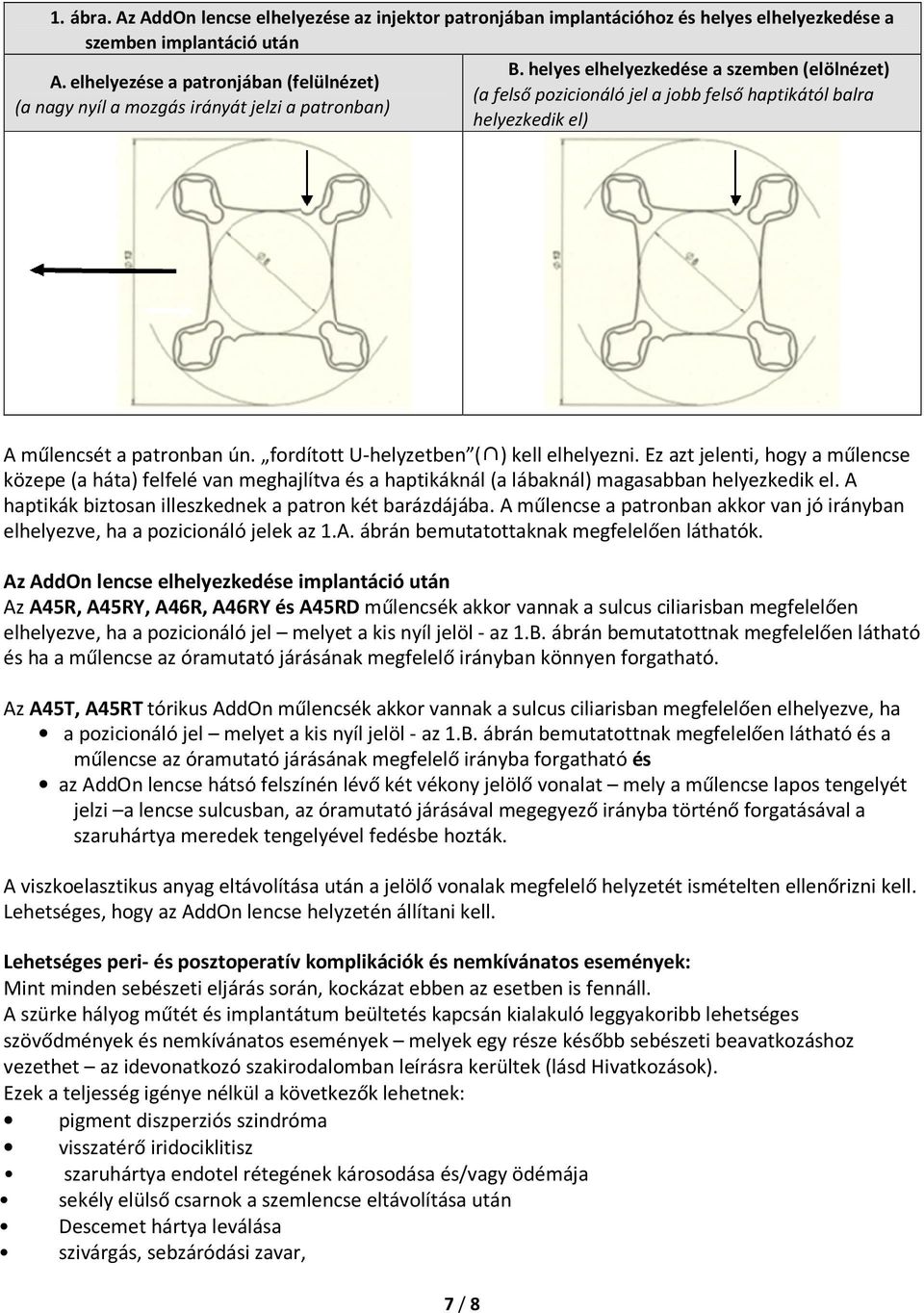 fordított U-helyzetben ( ) kell elhelyezni. Ez azt jelenti, hogy a műlencse közepe (a háta) felfelé van meghajlítva és a haptikáknál (a lábaknál) magasabban helyezkedik el.