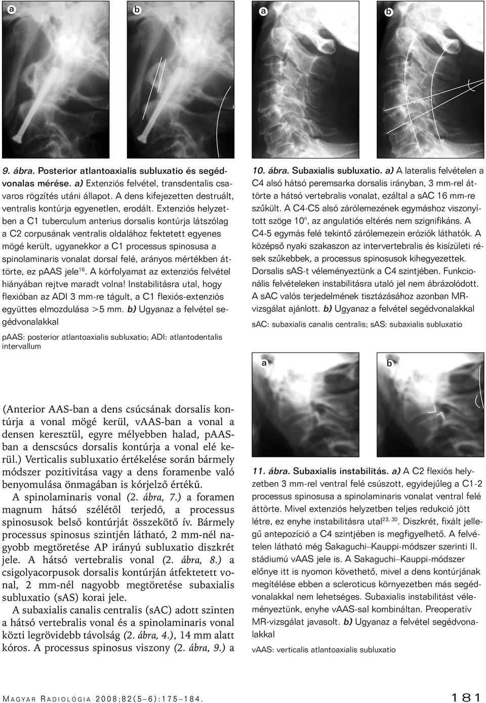 Extenziós helyzetben a C1 tuberculum anterius dorsalis kontúrja látszólag a C2 corpusának ventralis oldalához fektetett egyenes mögé került, ugyanekkor a C1 processus spinosusa a spinolaminaris