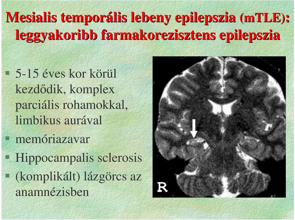 komplex parciális rohamokkal, limbikus aurával memóriazavar