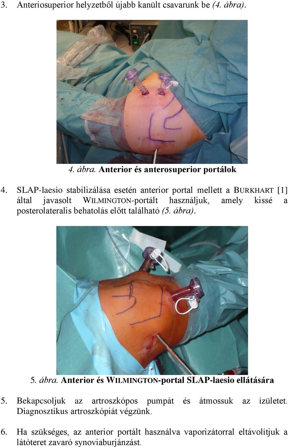 posterolateralis behatolás előtt található (5. ábra). 5. ábra. Anterior és WILMINGTON-portal SLAP-laesio ellátására 5.