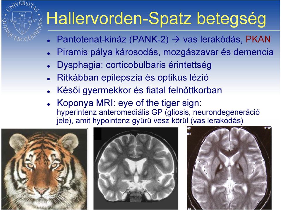 lézió Késői gyermekkor és fiatal felnőttkorban Koponya MRI: eye of the tiger sign: hyperintenz