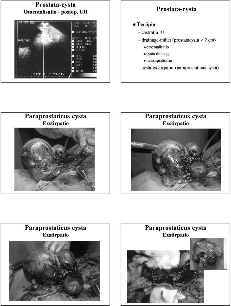 marsupialisatio cysta cysta--exstirpatio (paraprostaticus cysta) Paraprostaticus