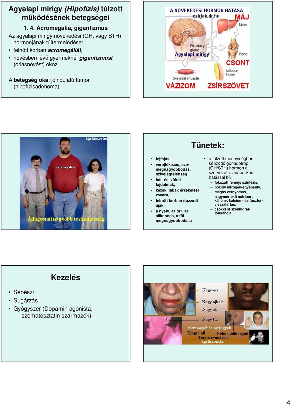 jóindulatú tumor (hipofízisadenoma) Tünetek: fejfájás, verejtékezés, szív megnagyobbodás, szívelégtelenség hát- és izületi fájdalmak, kezek, lábak érzékelési zavara, felnőtt korban duzzadt ajak, a