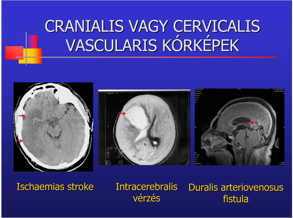 Ischaemias as stroke