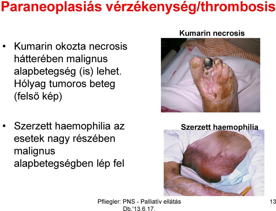 Hólyag tumoros beteg (felső kép) Kumarin necrosis Szerzett