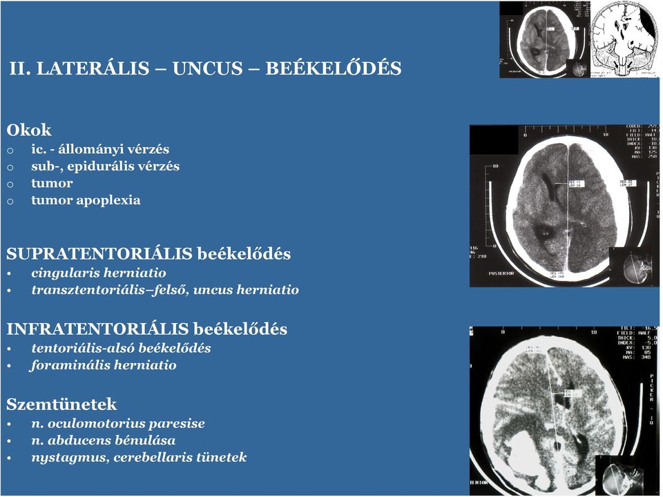 beékelődés cingularis herniati transztentriális felső, uncus herniati INFRATENTORIÁLIS