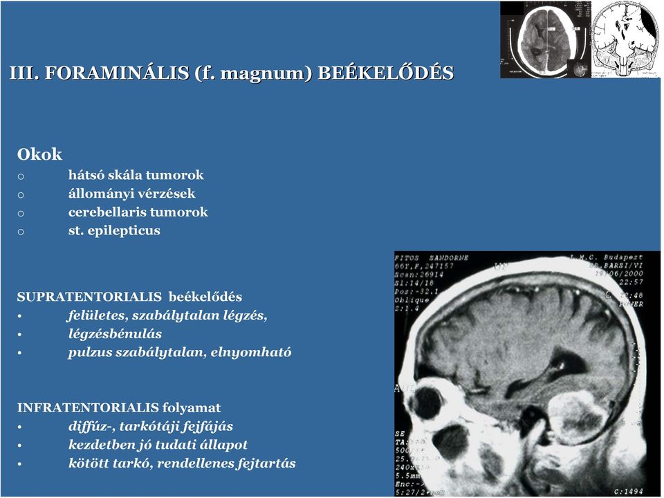 epilepticus SUPRATENTORIALIS beékelődés felületes, szabálytalan légzés,