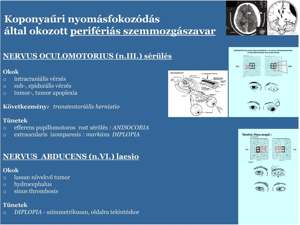 transtentriális herniati Tünetek efferens pupillmtrs rst sérülés : ANISOCORIA extracularis izmparesis :