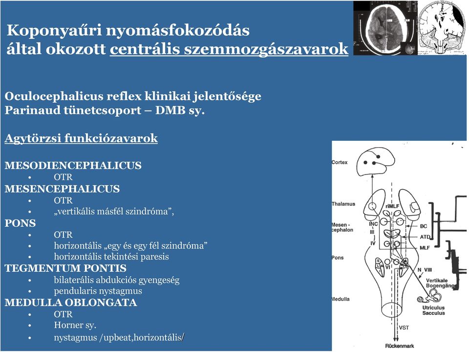 Agytörzsi funkciózavark MESODIENCEPHALICUS OTR MESENCEPHALICUS OTR vertikális másfél szindróma, PONS OTR