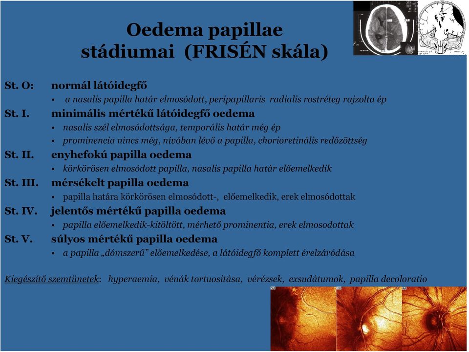 még, nívóban lévő a papilla, chriretinális redőzöttség enyhefkú papilla edema körkörösen elmsódtt papilla, nasalis papilla határ előemelkedik mérsékelt papilla edema papilla határa körkörösen