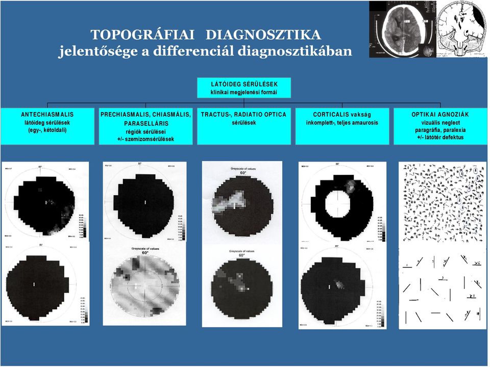 PARASELLÁRIS régiók sérülései +/- szemizmsérülések TRACTUS-, RADIATIO OPTICA sérülések CORTICALIS