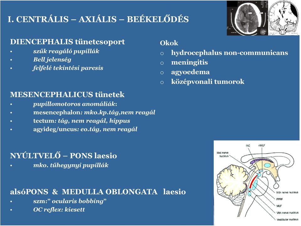 anmáliák: mesencephaln: mk.kp.tág,nem reagál tectum: tág, nem reagál, hippus agyideg/uncus: e.