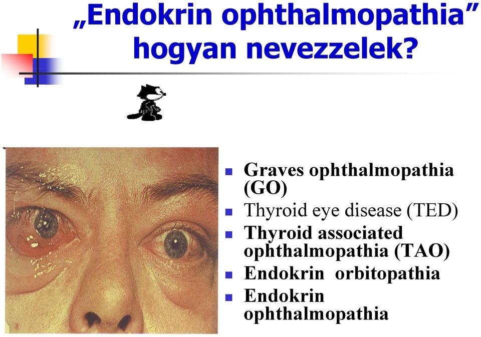 disease (TED) Thyroid associated ophthalmopathia