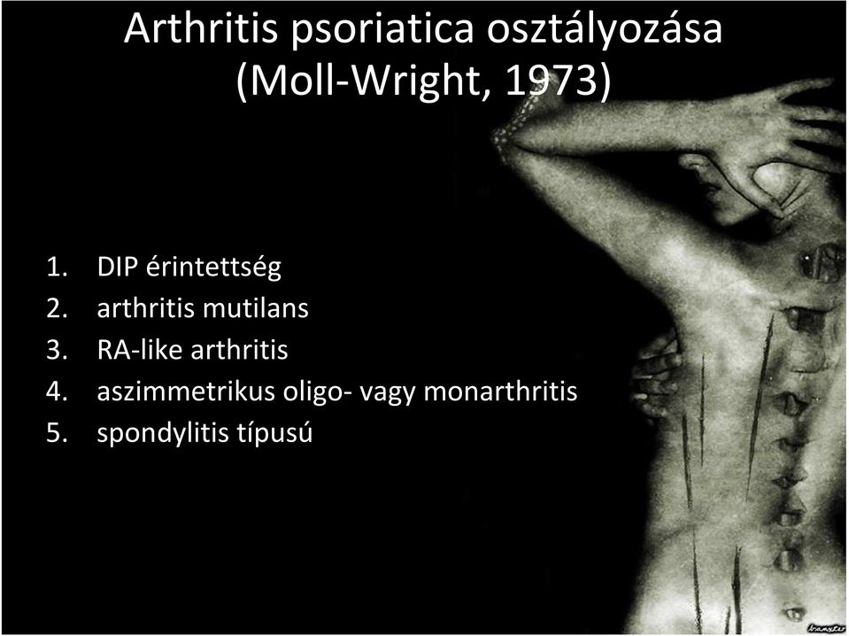 arthritis mutilans 3. RA-like arthritis 4.