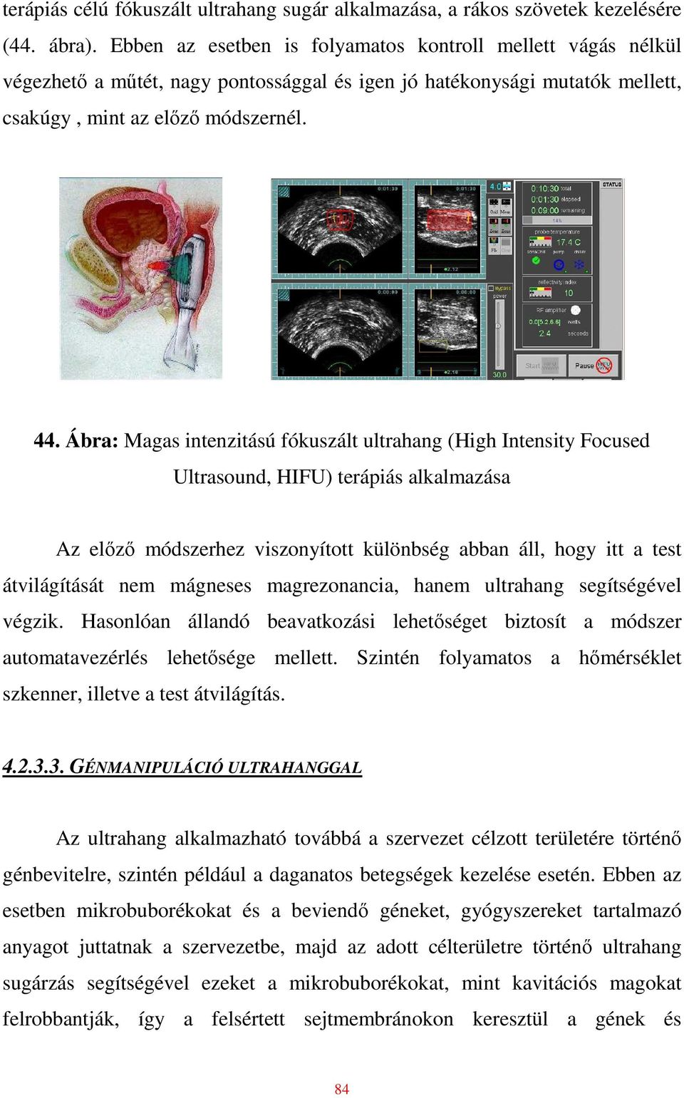 Ábra: Magas intenzitású fókuszált ultrahang (High Intensity Focused Ultrasound, HIFU) terápiás alkalmazása Az elızı módszerhez viszonyított különbség abban áll, hogy itt a test átvilágítását nem