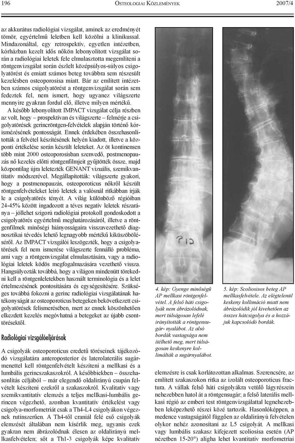 középsúlyos-súlyos csigolyatörést és emiatt számos beteg továbbra sem részesült kezelésben osteoporosisa miatt.