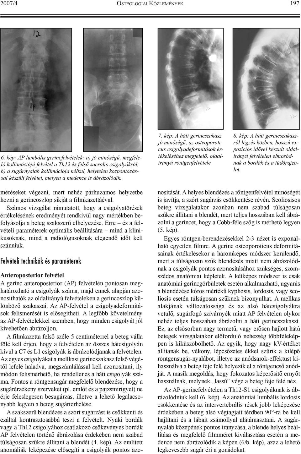 felvétel, melyen a medence is ábrázolódik. 7. kép: A háti gerincszakasz jó minõségû, az osteoporoticus csigolyadeformitások értékeléséhez megfelelõ, oldalirányú röntgenfelvétele. 8.