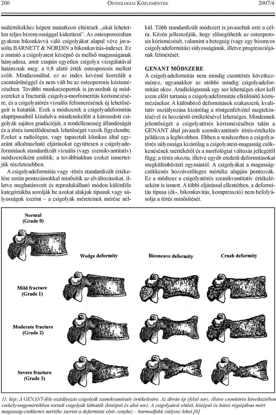 Ez a mutató a csigolyatest középsõ és mellsõ magasságának hányadosa, amit csupán egyetlen csigolya vizsgálatával határoztak meg; a 0,8 alatti érték osteoporosis mellett szólt.
