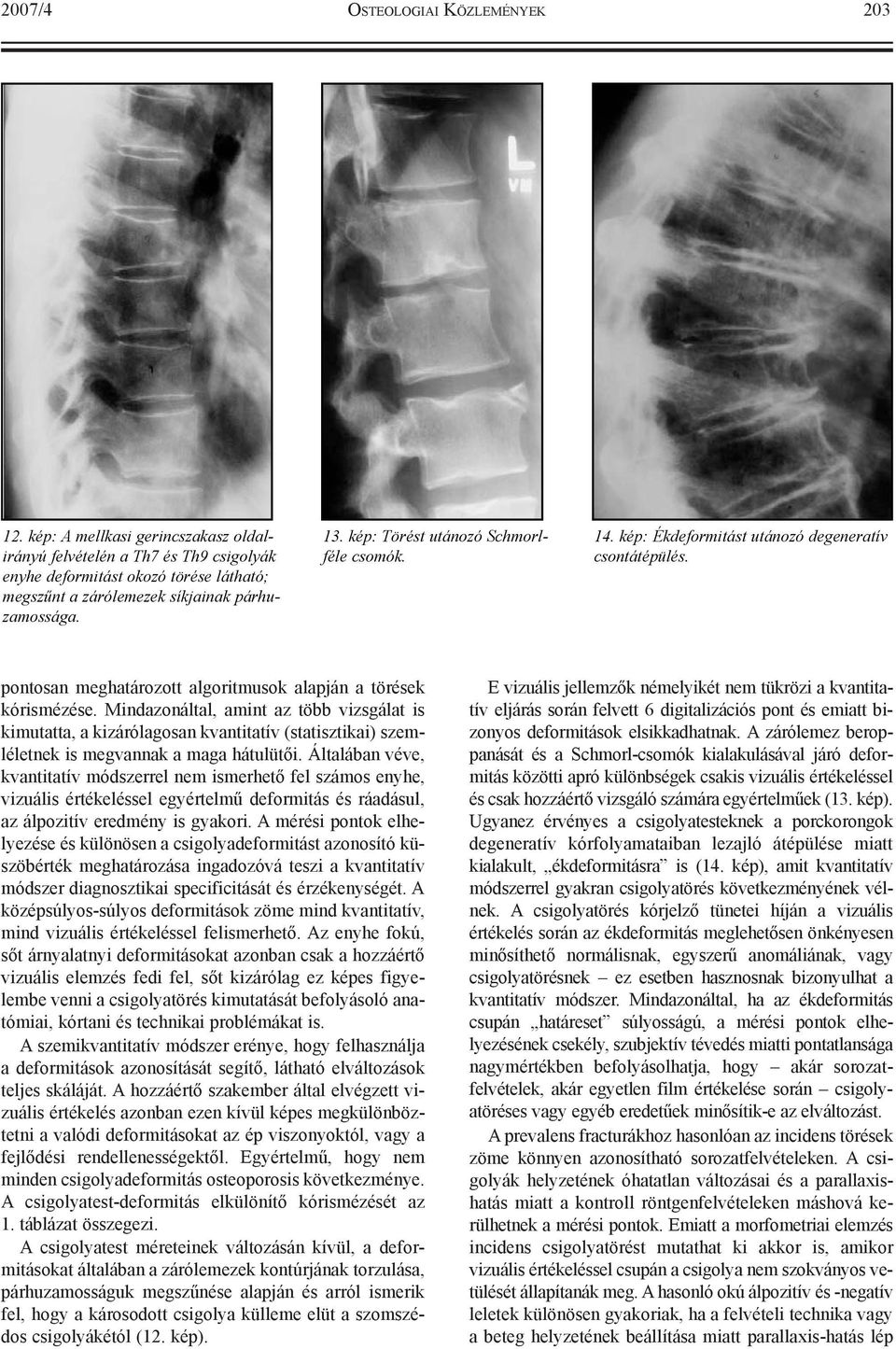 kép: Törést utánozó Schmorlféle csomók. 14. kép: Ékdeformitást utánozó degeneratív csontátépülés. pontosan meghatározott algoritmusok alapján a törések kórismézése.