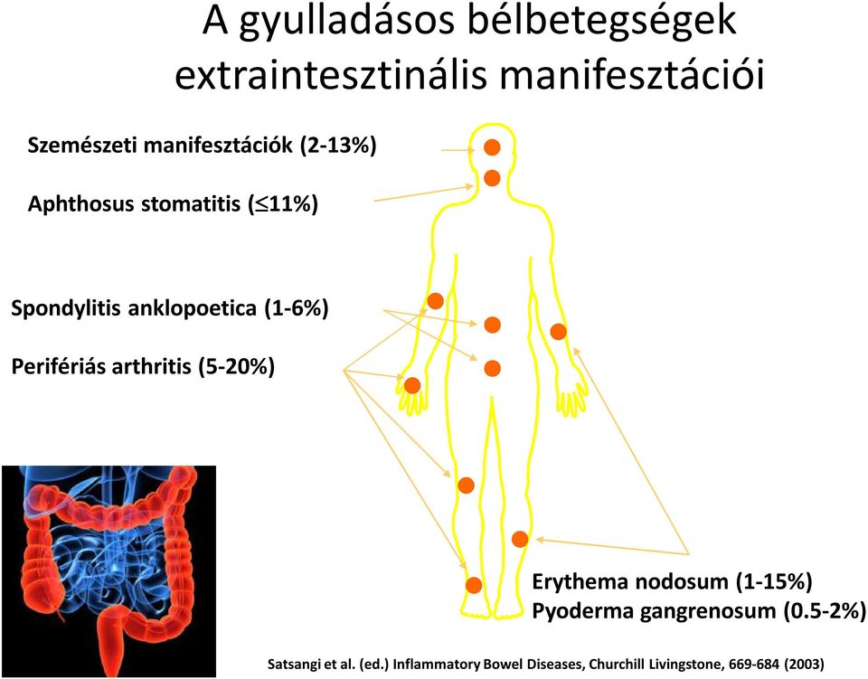 (1-6%) Perifériás arthritis (5-20%) Erythema nodosum (1-15%) Pyoderma gangrenosum