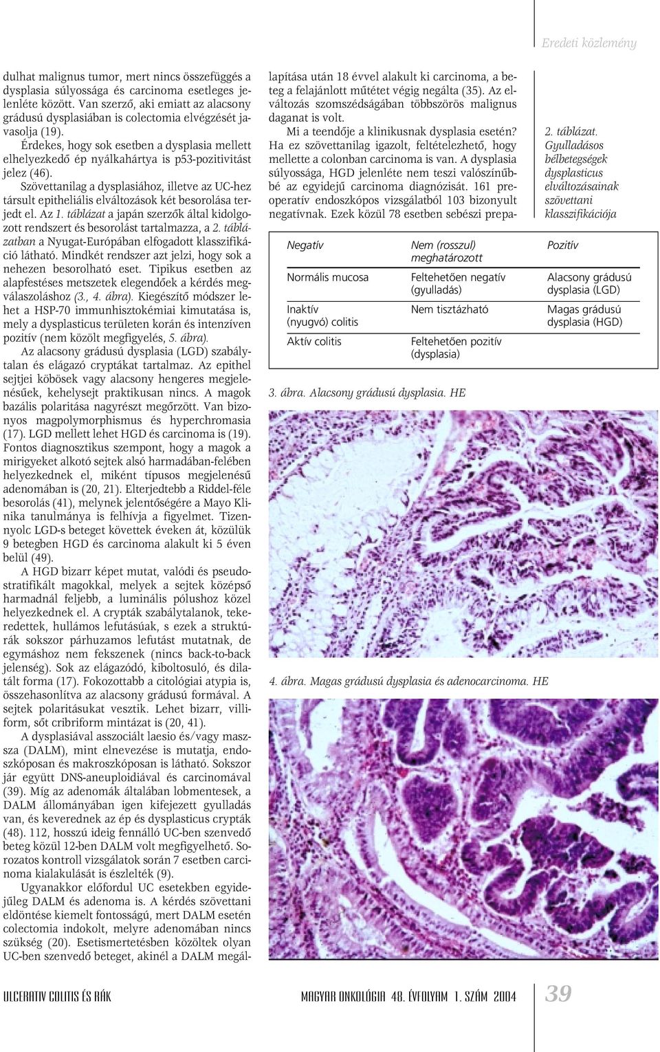 Érdekes, hogy sok esetben a dysplasia mellett elhelyezkedô ép nyálkahártya is p53-pozitivitást jelez (46).