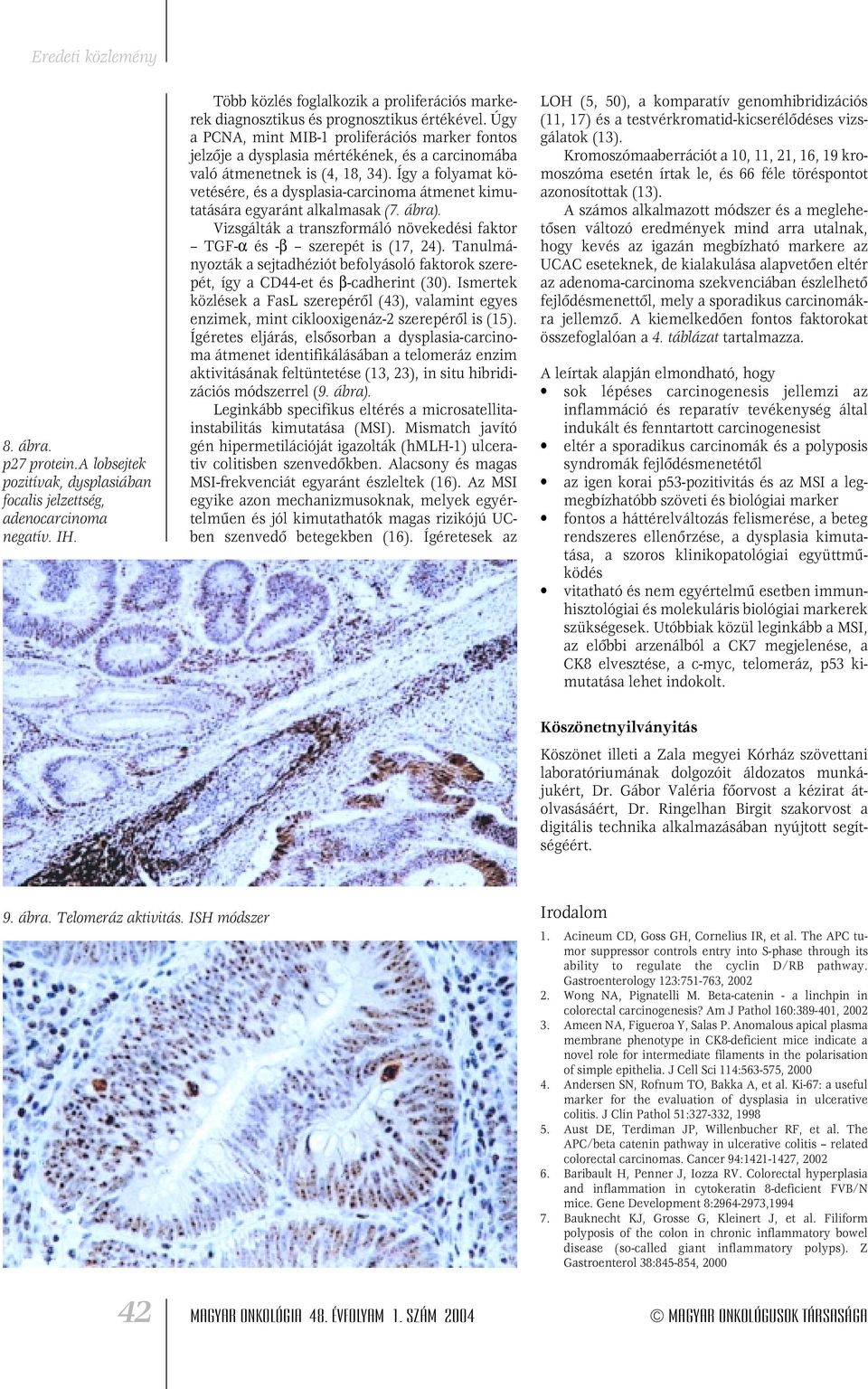 Így a folyamat követésére, és a dysplasia-carcinoma átmenet kimutatására egyaránt alkalmasak (7. ábra). Vizsgálták a transzformáló növekedési faktor TGF-α és -β szerepét is (17, 24).