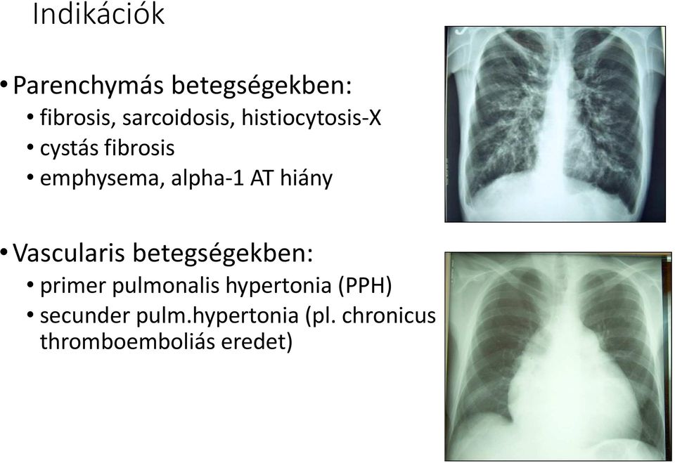 Vascularis betegségekben: primer pulmonalis hypertonia (PPH)