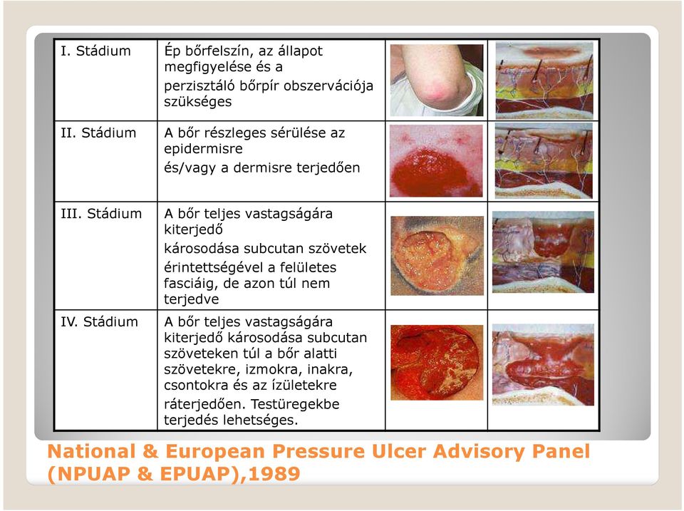 Stádium A bőr teljes vastagságára kiterjedő károsodása subcutan szövetek érintettségével a felületes fasciáig, de azon túl nem terjedve IV.