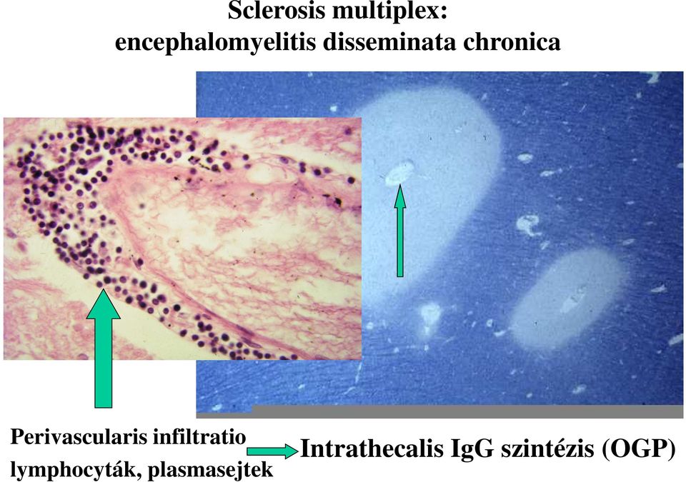 chronica Perivascularis infiltratio