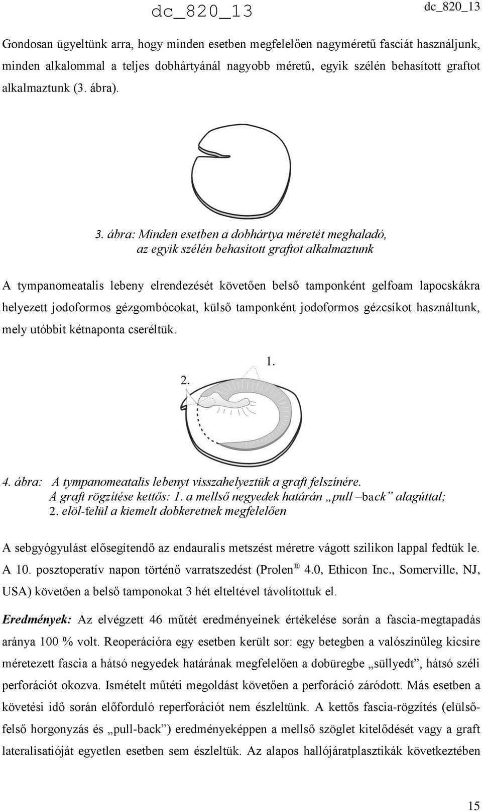 jodoformos gézgombócokat, külső tamponként jodoformos gézcsíkot használtunk, mely utóbbit kétnaponta cseréltük. 2. 1. 4. ábra: A tympanomeatalis lebenyt visszahelyeztük a graft felszínére.