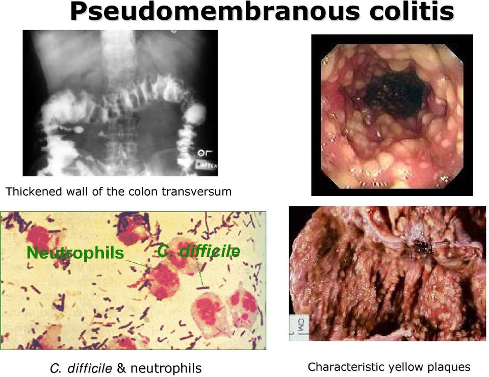 transversum C.