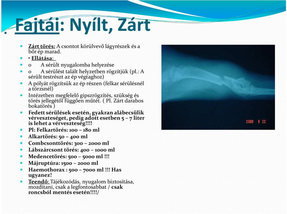 Zárt darabos bokatörés ) Fedett sérülések esetén, gyakran alábecsülik vérveszteséget, pedig adott esetben 5 7 liter is lehet a vérveszteség!