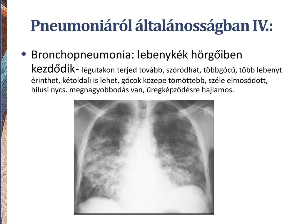 tovább, szóródhat, többgócú, több lebenyt érinthet, kétoldali is