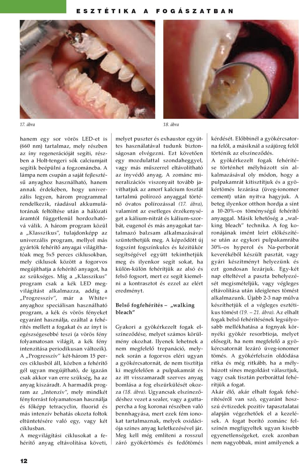 több ember fehéríteni, mint sötétíteni és ezért olyan ritka a fekete fog,  mint a fehér holló. Számos oka lehet a fogak elszíneződésének. - PDF Free  Download