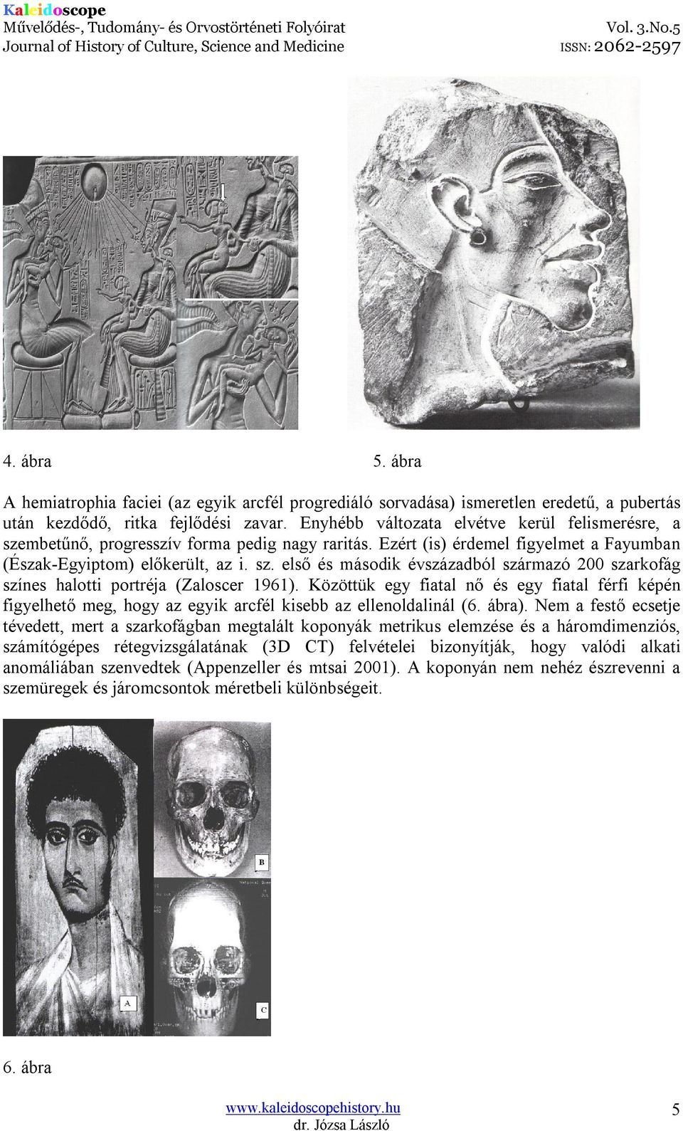Közöttük egy fiatal nő és egy fiatal férfi képén figyelhető meg, hogy az egyik arcfél kisebb az ellenoldalinál (6. ábra).