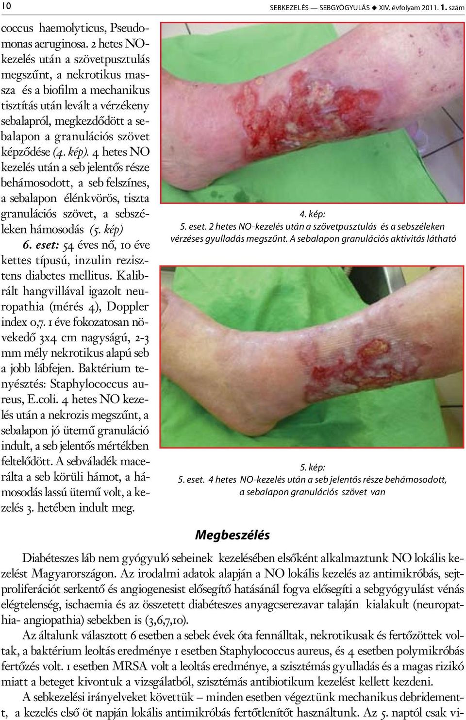 Diabéteszes láb - rettegett szövődmények - Dr. Zátrok Zsolt blog