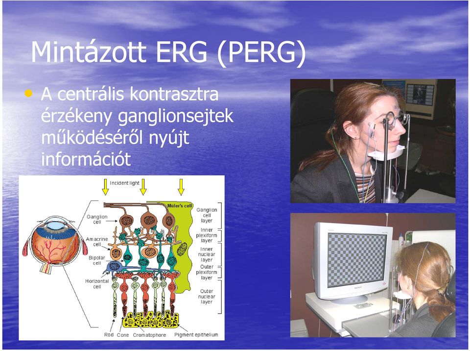 érzékeny ganglionsejtek