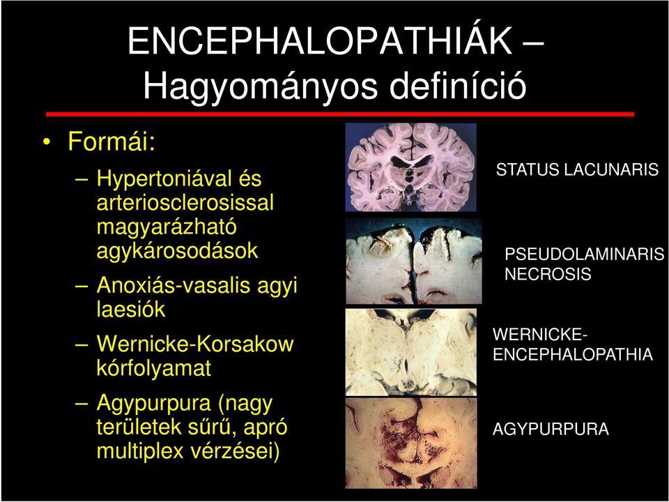 Wernicke-Korsakow kórfolyamat Agypurpura (nagy területek sűrű, apró