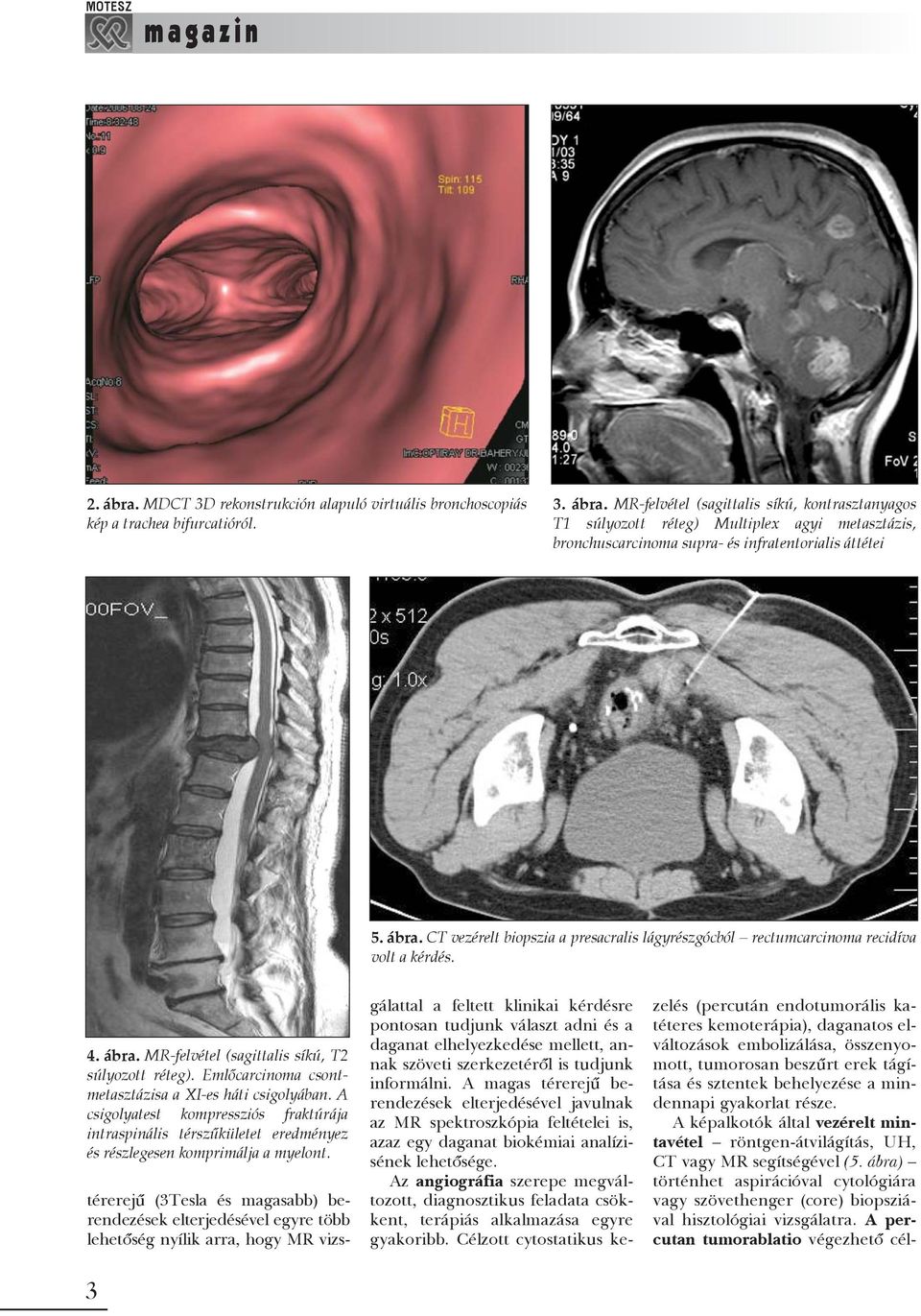 Emlõcarcinoma csontmetasztázisa a XI-es háti csigolyában. A csigolyatest kompressziós fraktúrája intraspinális térszûkületet eredményez és részlegesen komprimálja a myelont.